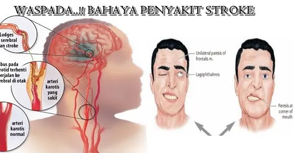 Rahasia Mujarab Cara Tuhan Mengobati Stroke