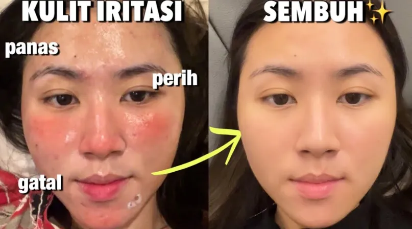 8 Rahasia Ampuh Mengatasi Muka Merah Dan Panas Secara Alami